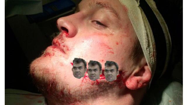 PHOTOS. PREMIERSHIP. Le pilier Nicholas Schonert défiguré après avoir reçu un coup de crampon